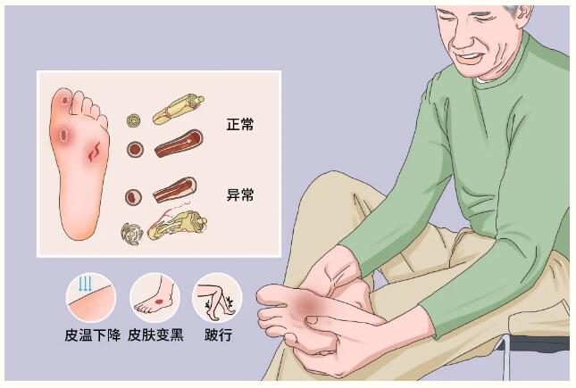 衡阳华程医院骨科新技术:糖尿病足抗生素骨水泥覆盖技术